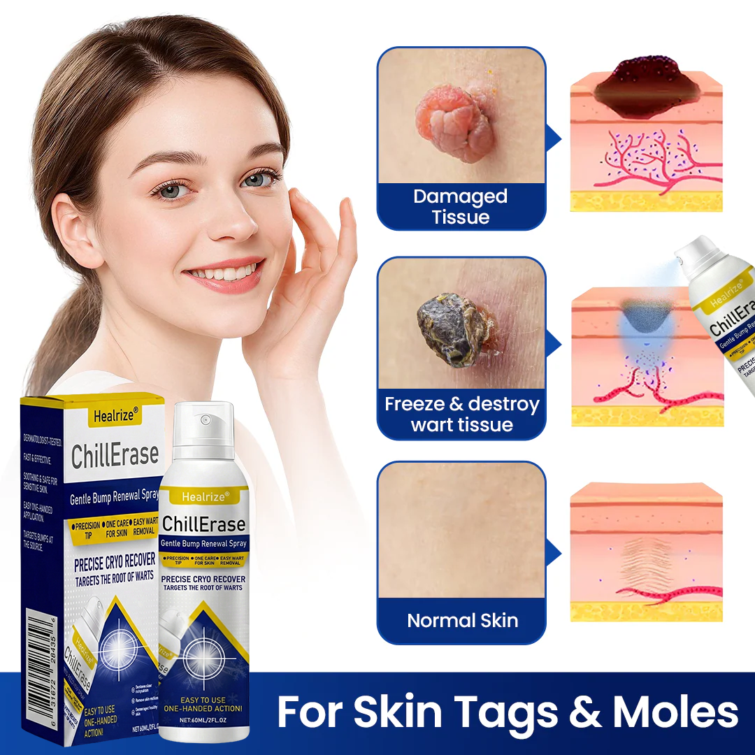 ❄️✅Healrize®ChillErase Gentle Bump Renewal Spray — Pain-Free, Acid-Free Gentle Wart Removal