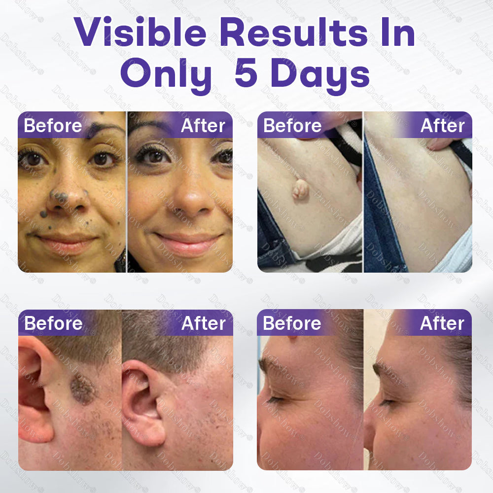 Dobshow® Wart and mole removal microneedle patch