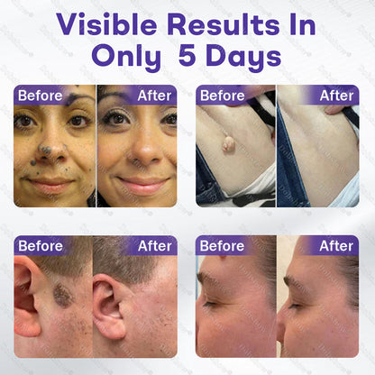 Dobshow® Wart and mole removal microneedle patch