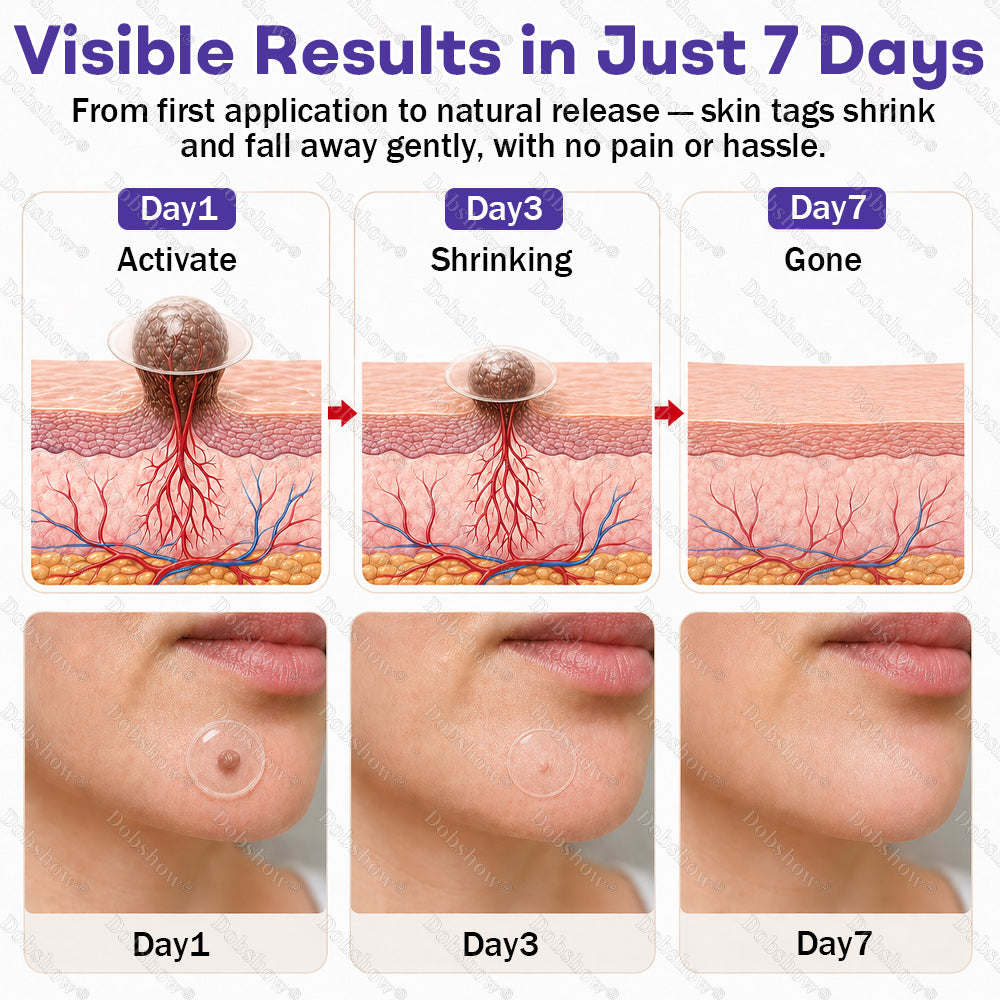 Dobshow® Wart and mole removal microneedle patch