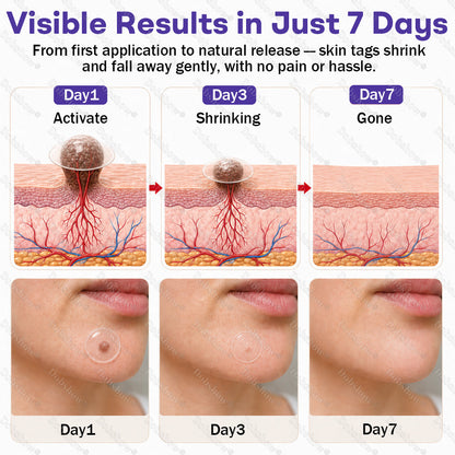 Dobshow® Wart and mole removal microneedle patch