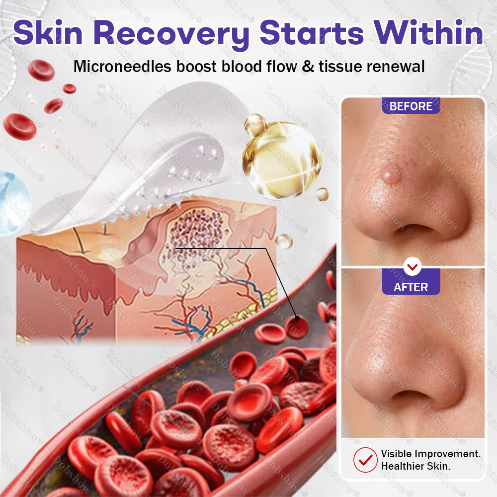Dobshow® Wart and mole removal microneedle patch
