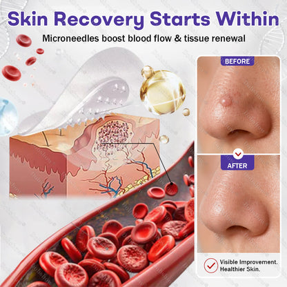 Dobshow® Wart and mole removal microneedle patch