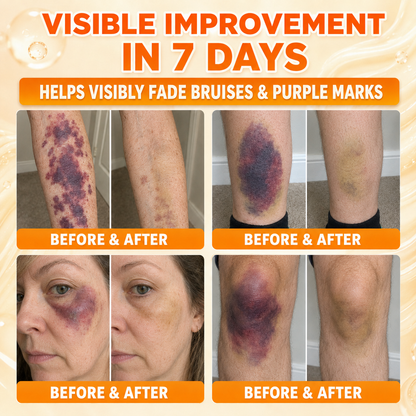 𝐇𝐞𝐚𝐥𝐫𝐢𝐳𝐞® Premium Vitamin K Bruise Repair Cream
